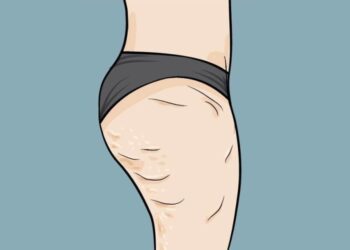 How to get rid of cellulite