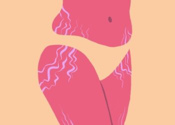 Homemade remedies to treat stretch marks